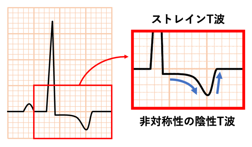 ストレインT波
ストレインT波は左室肥大に伴う二次性の再分極異常を表しています。正常では心外膜側から心内膜側へ向かって再分極が進みますが、肥大した心筋では興奮伝播が遅れるので再分極の順序が逆転し、心内膜側が先に再分極して心外膜側の再分極が遅れることで再分極ベクトルが逆転しST低下と陰性T波が生じます。T波は非対称性で緩徐な上に凸の下降部分と急峻な上行部分が存在します。