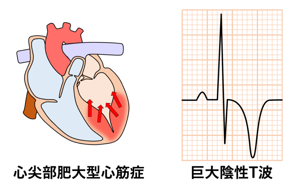 肥大型心筋症(hypertrophic cardiomyopathy)
巨大陰性T波が最も特徴的にみられるのは心尖部肥大型心筋症ですが、純粋な心尖部肥大だけでなく心尖部優位の肥大を伴う混合型でも出現します。心尖部の著明な肥大によって心尖部心筋の再分極が著しく遅延するので再分極ベクトルが心尖部から心基部方向に向いて左前胸部誘導で深い陰性T波として記録されます。心尖部に肥大が限局しているため、他の部位からのベクトルによる相殺(cancellation)が少なく大きなT波が形成されやすいです。