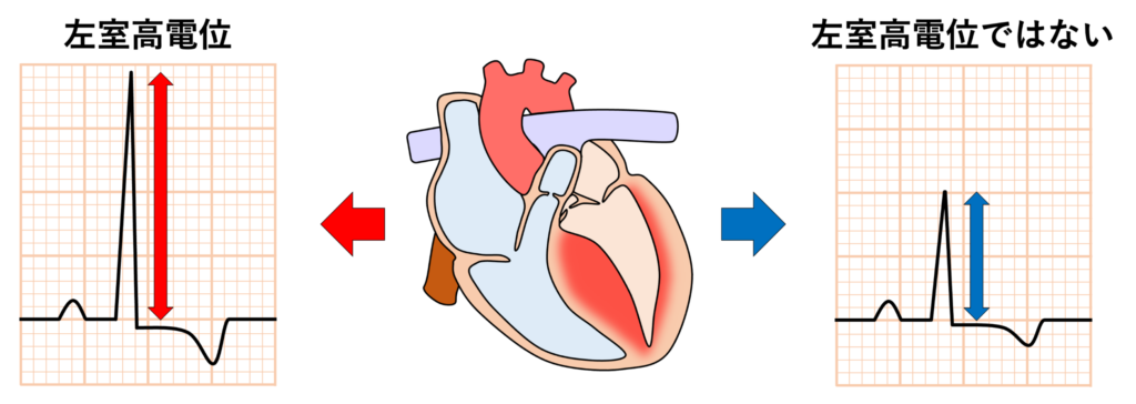 肥大型心筋症(hypertrophic cardiomyopathy)
肥大型心筋症では左室心筋の肥大により、心電図上で左室高電位が高頻度に認められます。高電位基準を満たすものは約40〜70%程度と報告されていますが、これらの基準を満たしても実際の壁厚との相関は弱いことが知られています。そのため壁厚が30mmを超えるような高度肥大でも高電位基準を満たさない場合がありますし、逆に比較的軽度の肥大でも高電位を示す場合があります。高電位単独では診断確定にはならないため必ず心エコーやMRIで壁厚を評価する必要があります。