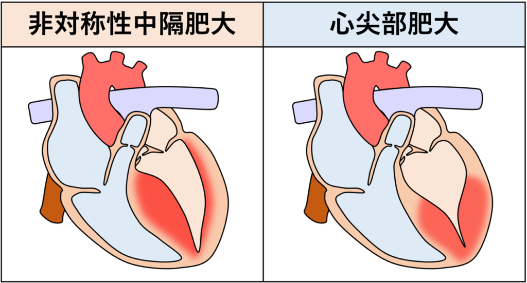 肥大型心筋症(hypertrophic cardiomyopathy)
肥大型心筋症とは、高血圧や弁膜症などの明らかな負荷要因がないにもかかわらず左心室の心筋が異常に肥厚する心筋疾患です。原因の多くはサルコメア関連遺伝子の変異による遺伝性疾患で常染色体顕性遺伝を示します。心エコーまたは心臓MRIのいずれかで左室壁厚が15mm以上、家族歴や遺伝子変異が明らかな場合は13〜14mmでも診断可能です。心筋の肥厚パターンが多様であり、非対称性中隔肥大、心尖部肥大、びまん性肥大などがあります