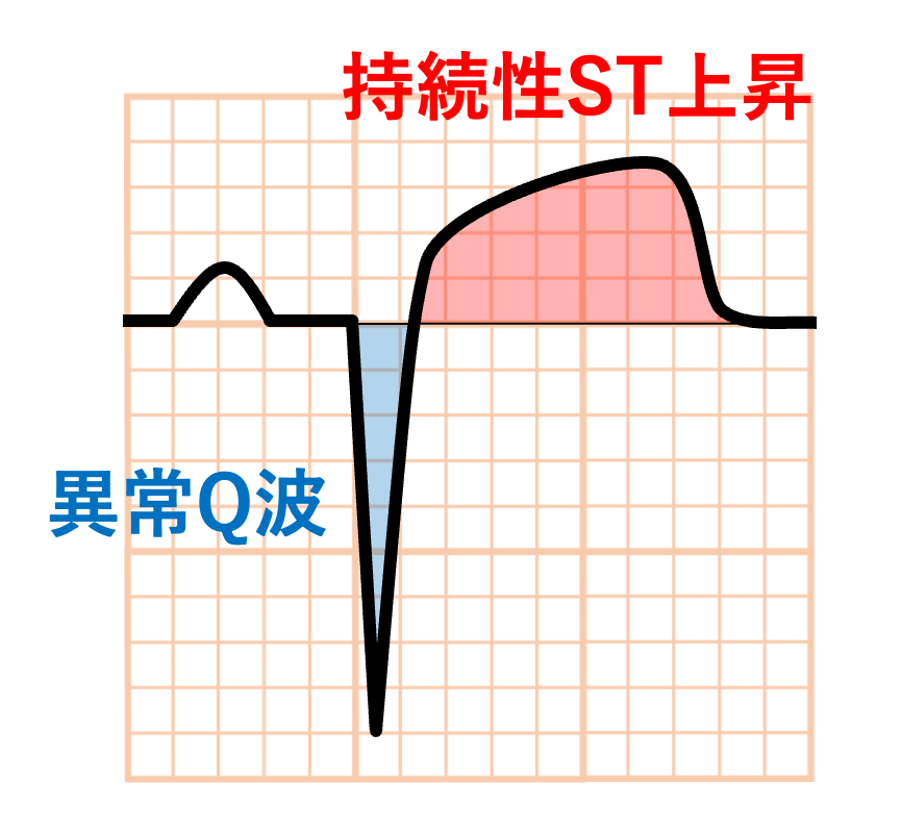 心室瘤(aneurysm)
心室瘤の心電図所見として異常Q＋持続性ST上昇が古典的パターンです。陳旧性心筋梗塞で異常Q波のある誘導にST上昇が数週間以上持続する場合に心室瘤を疑います。ただし感度が低く、ST上昇がなくても心室瘤が存在する例も少なくありません。
