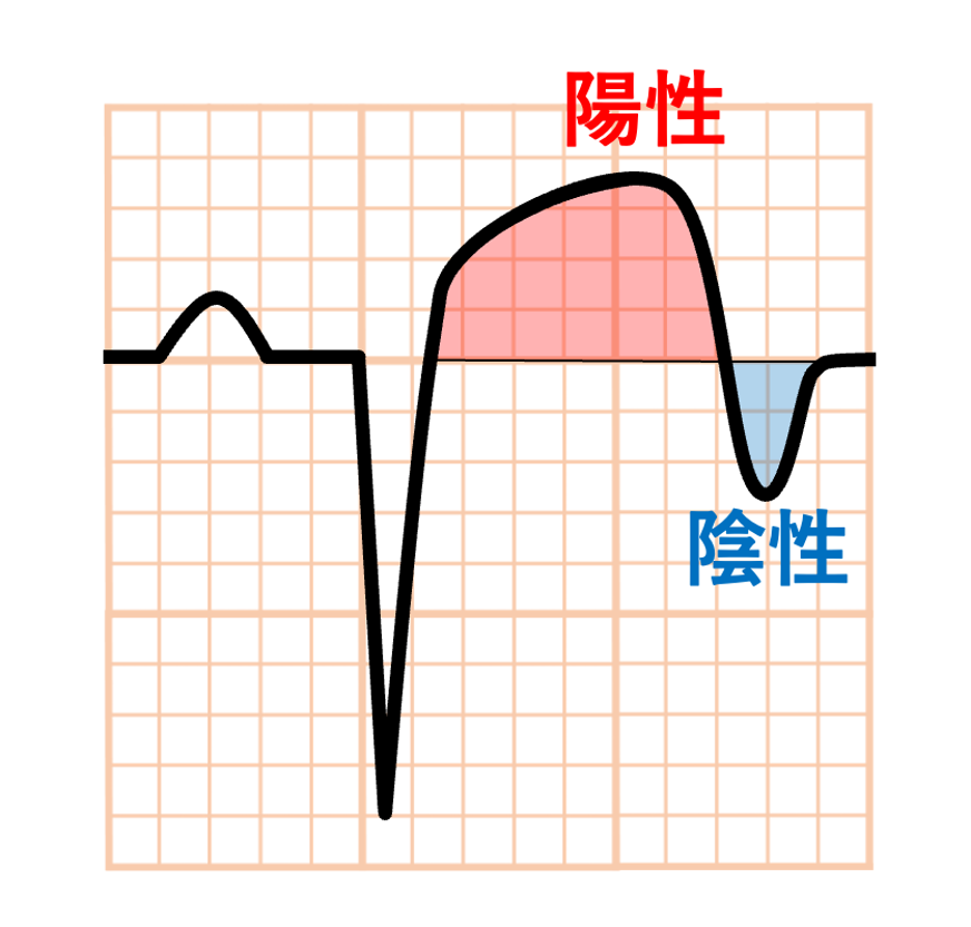 心室瘤(aneurysm)