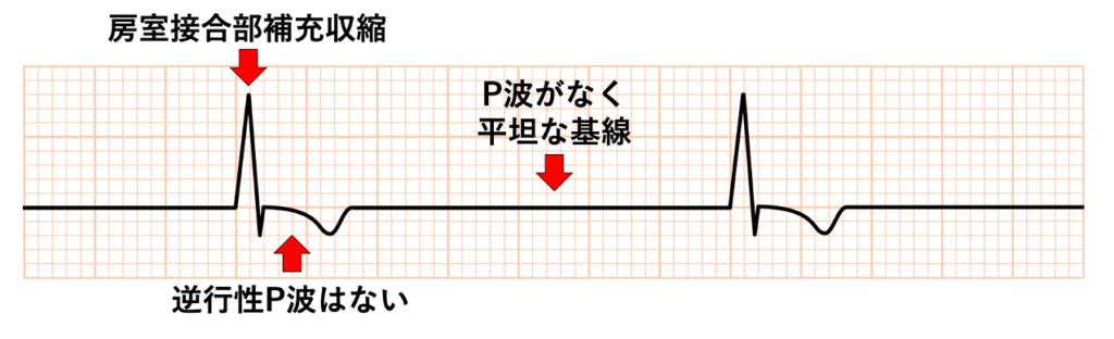心房静止(atrial standstill)
心房波であるP波・f波・F波が消失して基線は平坦になります。心室は下位中枢(多くは房室接合部)の補充調律で維持されます。房室接合部調律であればQRS波は通常narrowで、規則的な徐脈となり心拍数30〜50回/分前後となります。一部の心房組織だけが静止する部分的心房静止では残存部位の低振幅P波が見えることがあります。