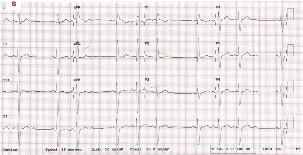 非定型Wenckebach型Ⅱ度房室ブロック(atypical Wenckebach second degree AV block)