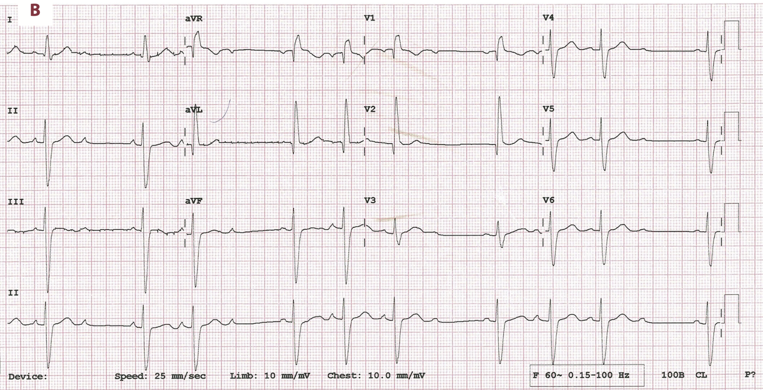 非定型Wenckebach型Ⅱ度房室ブロック(atypical Wenckebach second degree AV block)