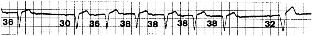 非定型Wenckebach型Ⅱ度房室ブロック(atypical Wenckebach second degree AV block)