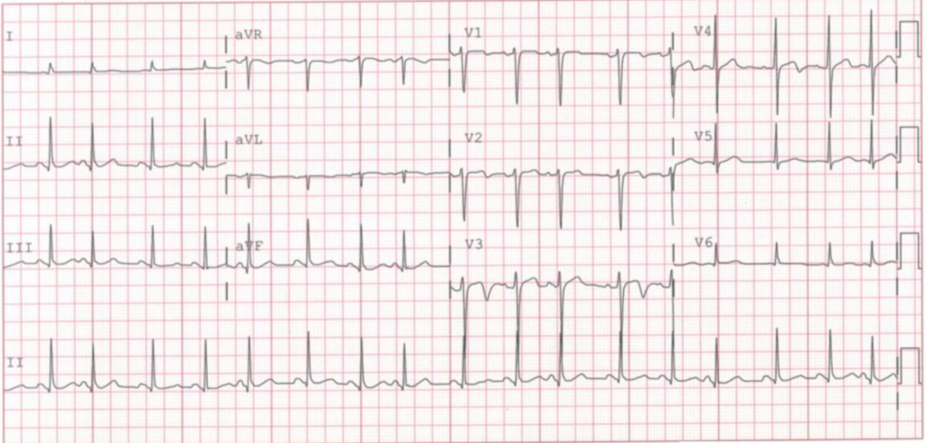 期外収縮後T波変化(postextrasystolic T wave changes)