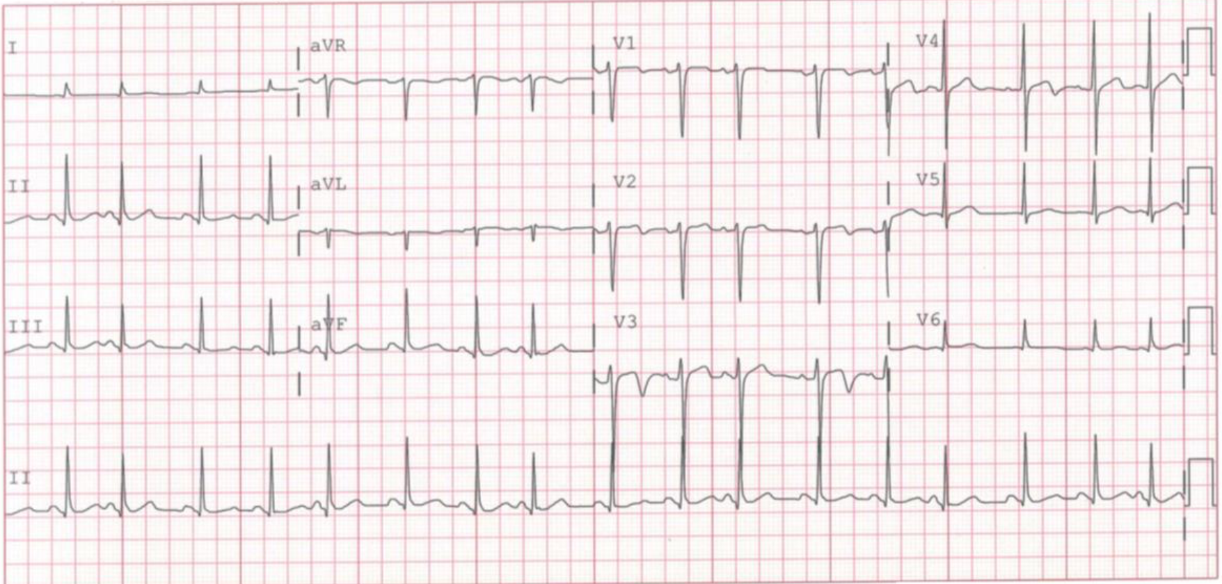 期外収縮後T波変化(postextrasystolic T wave changes)
