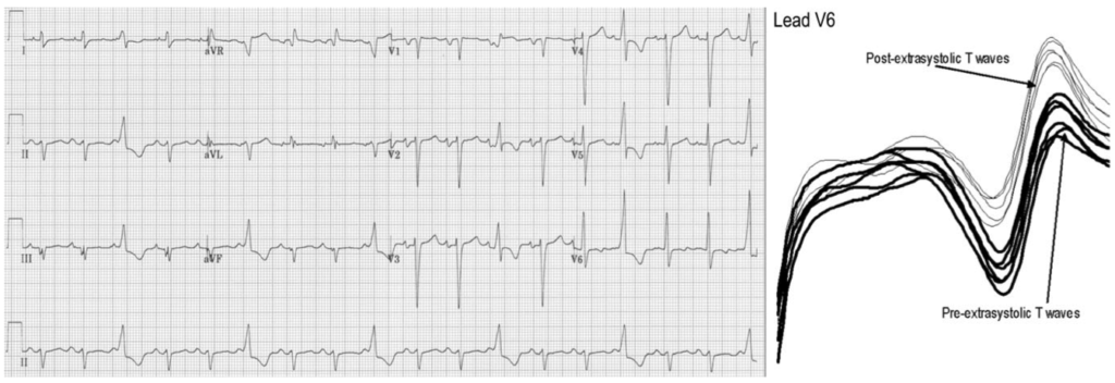 期外収縮後T波変化(postextrasystolic T wave changes)
