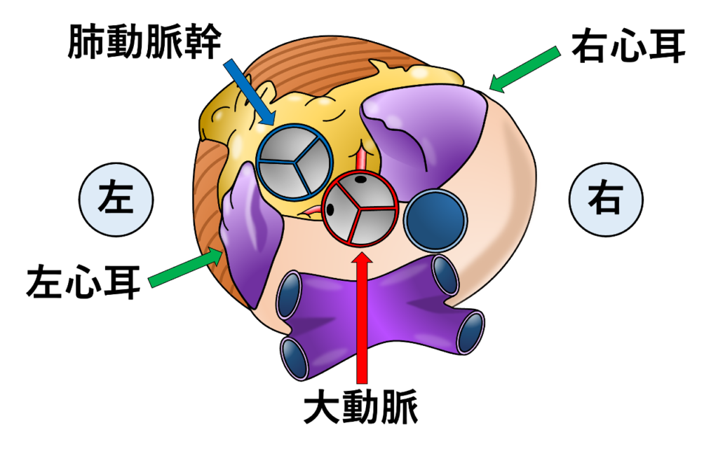 右心耳(right atrial appendage)
右心耳は上行大動脈の右前方に張り出すように存在し、大動脈基部〜上行大動脈の右側面・前面を部分的に覆うような位置関係です。一方、左心耳は肺動脈幹の左側に位置するので、左右の心耳は大血管(大動脈・肺動脈幹)を挟むような配置になります。