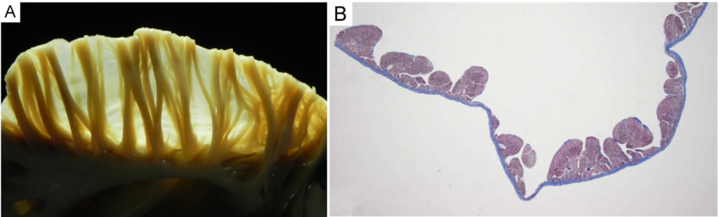 右心耳(right atrial appendage)
右心耳では櫛状筋そのものは厚い筋束ですが、その筋束と筋束の間にある壁は非常に薄くなります。そのため肉眼標本では場所によって光が透けるほど薄く見えることがあります。右心耳はその薄さゆえに穿孔・損傷しやすい部位であり、臨床的にはカテーテルやリード挿入時に注意が必要になります。