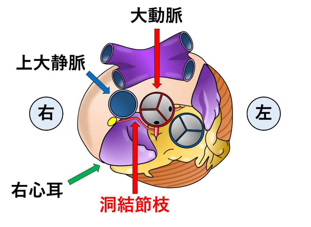 右心耳(right atrial appendage)
右冠動脈は大動脈基部と右心耳の間から右房室溝へ向かいますが、洞結節枝が右冠動脈近位部から分岐した場合(70%程度)、右心耳の内側を上行し、右心耳と上行大動脈の間を走行して上大静脈‐右房接合部の洞結節へ向かいます。洞結節枝は冠動脈の中でもかなりバリエーションが多い血管であり、約70%が右冠動脈から分岐しています。