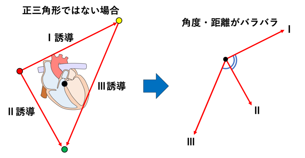 Einthovenの三角形(Einthoven’s Triangle)