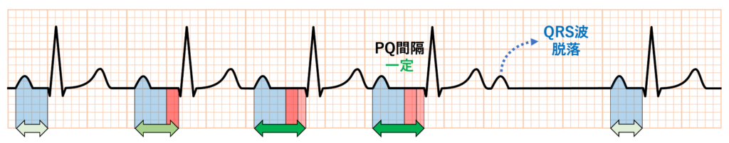 非定型Wenckebach型Ⅱ度房室ブロック(atypical Wenckebach second degree AV block)