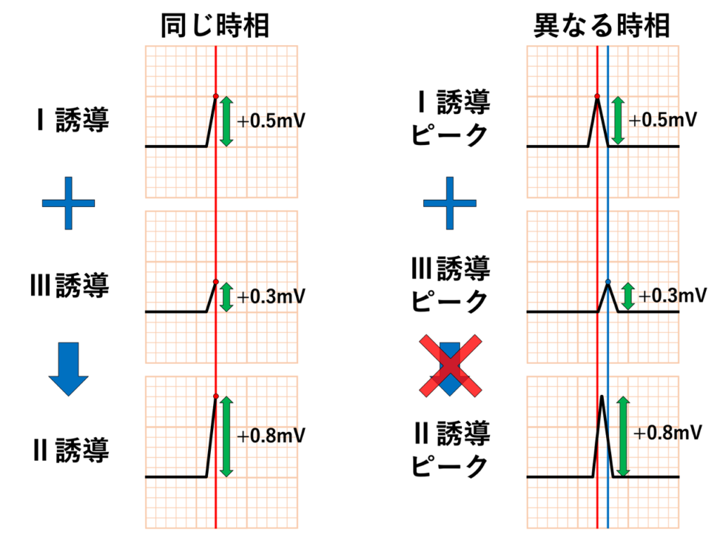 Einthovenの法則(Einthoven's law)
つまり、P波・QRS波・ST部分・T波のどこであっても、同じ時相の瞬時電位をそろえてI誘導とIII誘導を足せば、理論上はII誘導のその時点の電位になります。たとえば、QRS波のある瞬間で「I = +0.5mV、III = +0.3mV」なら、「II = +0.8mV」となります。重要なのは「各誘導のR波の高さを足す」といった波形の最大振幅同士の計算ではないことです。R波含め各波形のピークの時刻は誘導によって異なる可能性があるため、あくまで時間軸をそろえた同一の時相の電位を足し合わせる必要があります。