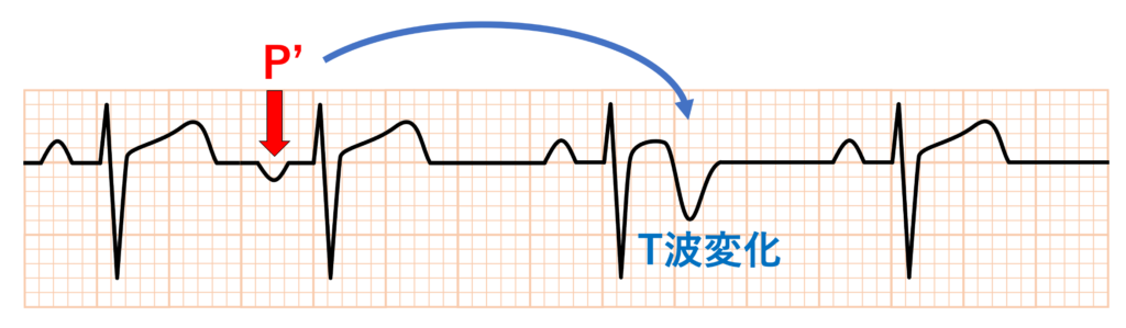 期外収縮後T波変化(postextrasystolic T wave changes)