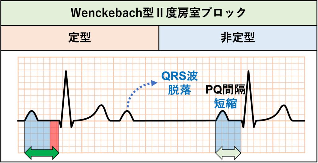 非定型Wenckebach型Ⅱ度房室ブロック(atypical Wenckebach second degree AV block)