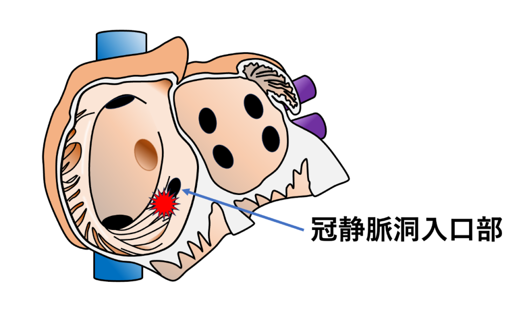 冠静脈洞入口部起源

冠静脈洞入口部(CS ostium)とは冠静脈洞が右房へ開口する部位であり、右房後下部に存在しています。ここを起源とする心房期外収縮が冠静脈洞入口部起源の心房期外収縮と呼ばれます。