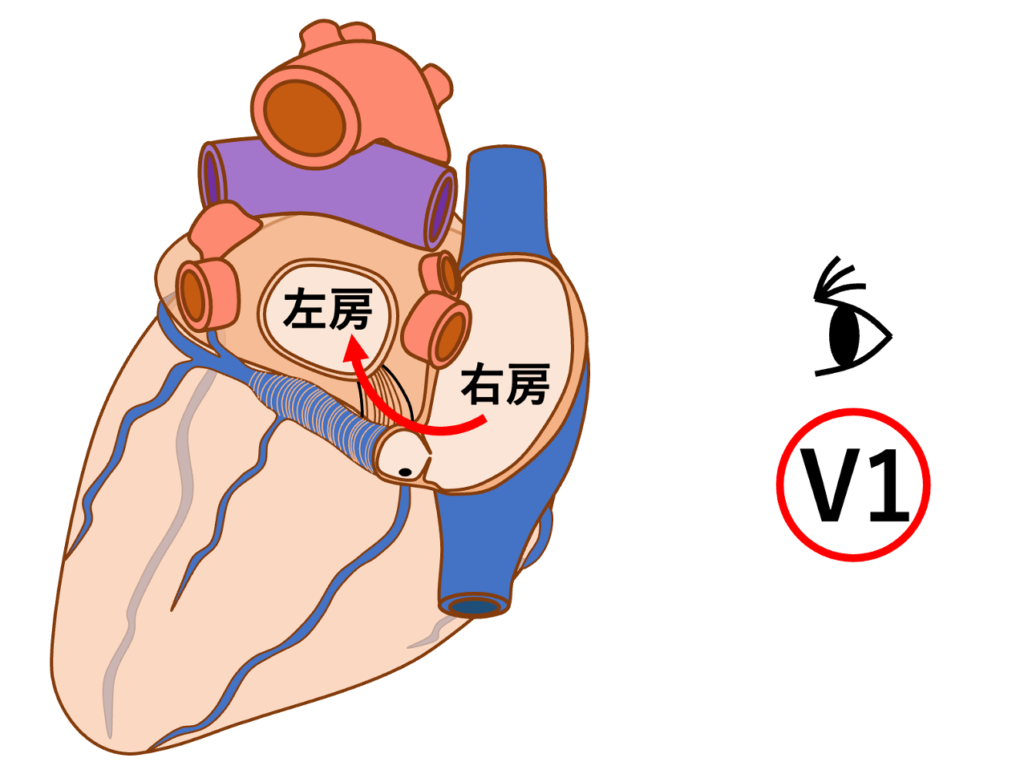 冠静脈洞入口部起源
冠静脈洞周囲の心筋束(冠静脈洞筋束)を介した心房間伝導により、興奮は早期に左房後下方へ伝わります。この興奮はV1誘導から遠ざかる方向のベクトル成分をもつため、V1誘導におけるP波の初期陰性成分の形成に関与すると考えられます。