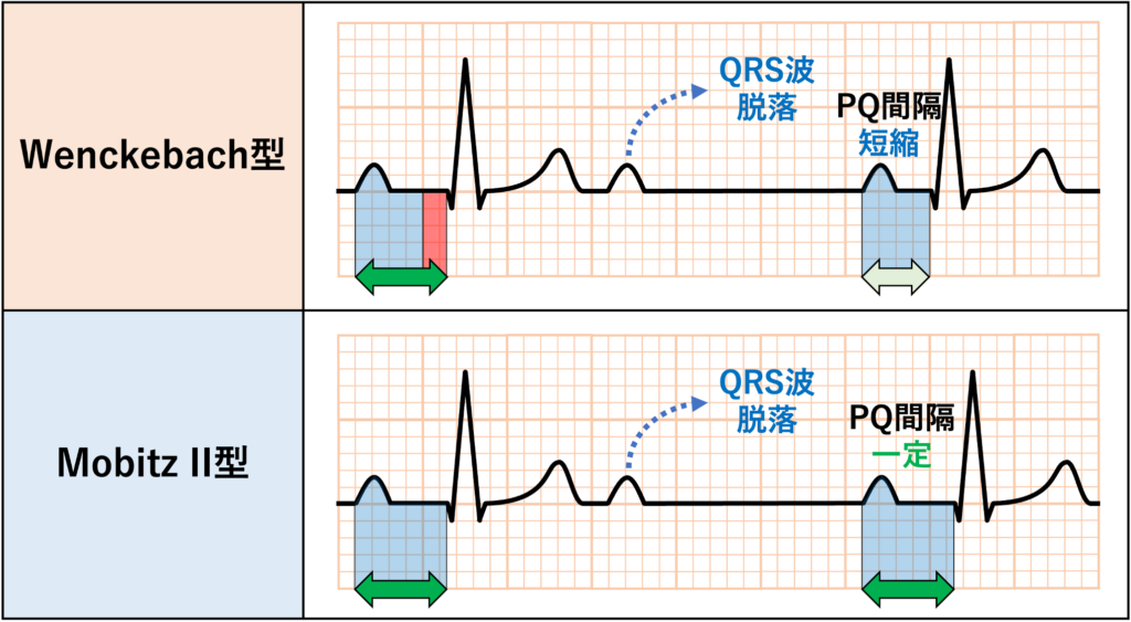 非定型Wenckebach型Ⅱ度房室ブロック(atypical Wenckebach second degree AV block)