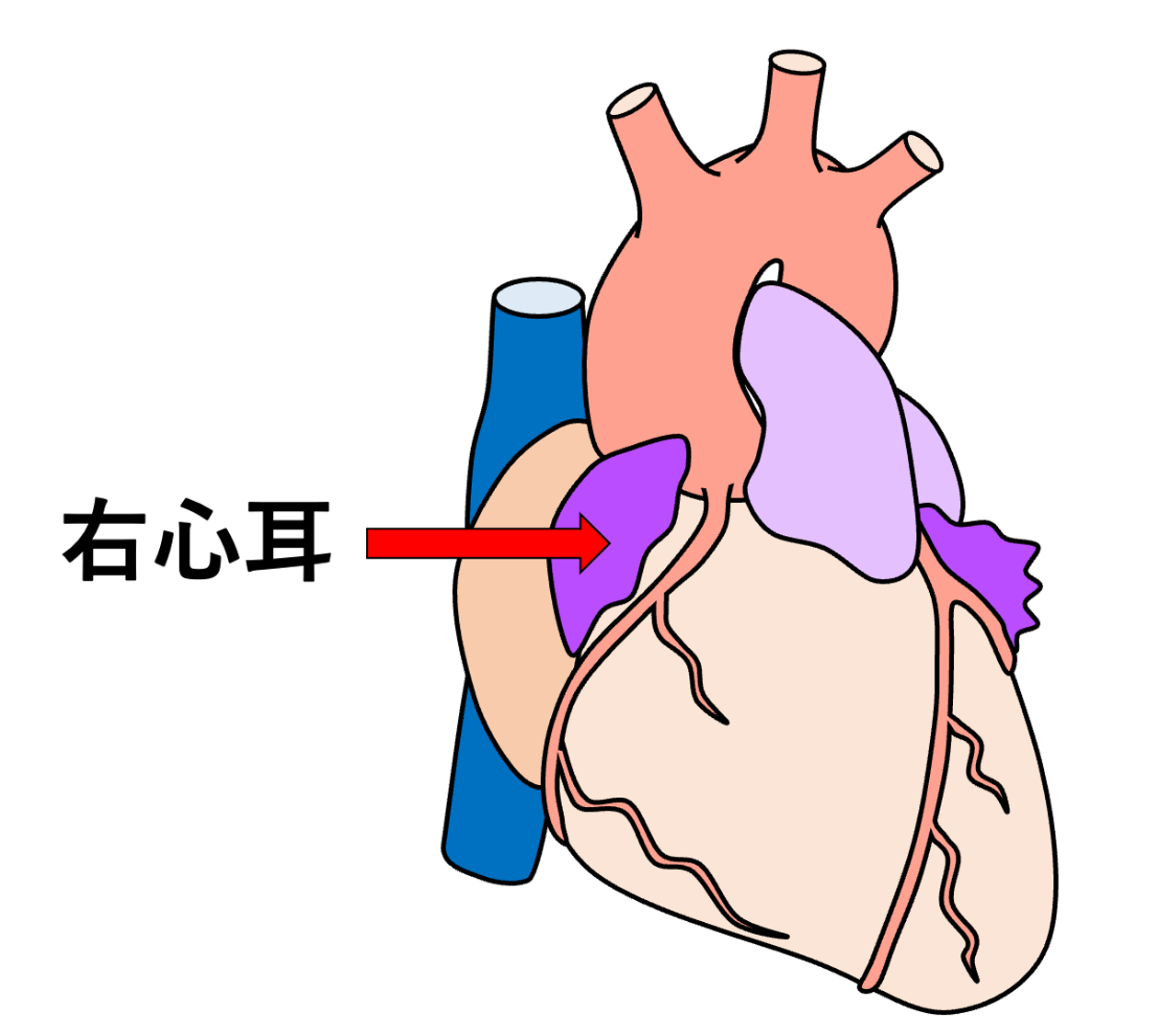 右心耳(right atrial appendage)