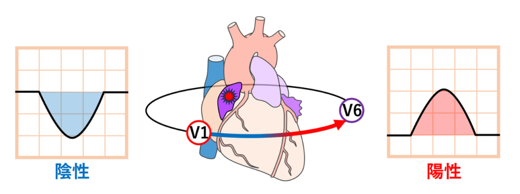 右心耳(right atrial appendage)
右心耳は洞結節より前方に位置するため、右心耳から異所性興奮が発生すると、興奮は前方から後方へ向かう成分を持ちます。このため右心耳起源の心房期外収縮や心房頻拍では、V1~V2誘導で陰性P波を呈し、その後の胸部誘導で徐々に陽性へ移行する特徴的なP波形態がみられることがあります。