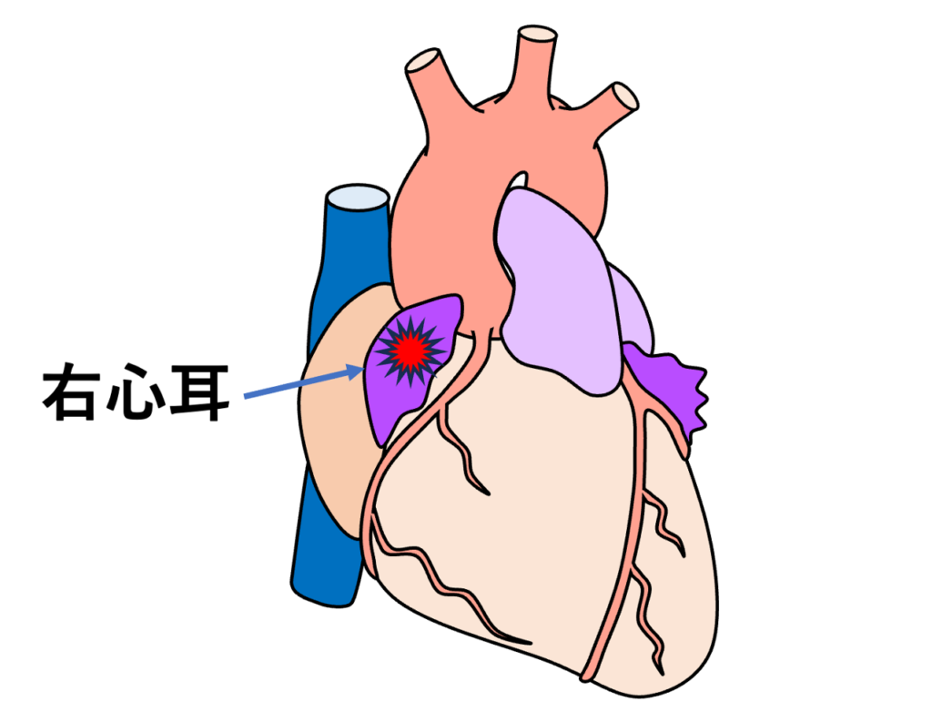 右心耳起源

右心耳とは右心房の前方から前上方へ突出する袋状の構造であり、上行大動脈の前〜右側へ覆いかぶさるように存在しています。ここを起源とする心房期外収縮が右心耳起源の心房期外収縮と呼ばれます。