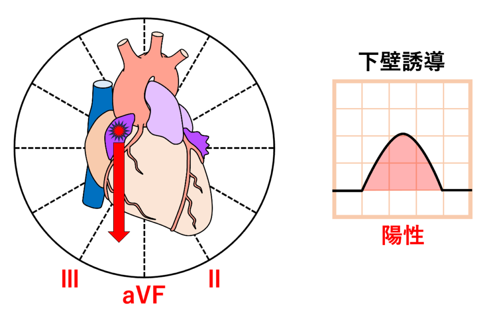 右心耳起源
右心耳は右房の前上方にあります。ここから興奮すると、全体として右前方 → 左方・後方・下方へ心房興奮が広がります。そのため、下方を向くベクトルによってII・III・aVF誘導は陽性になります。