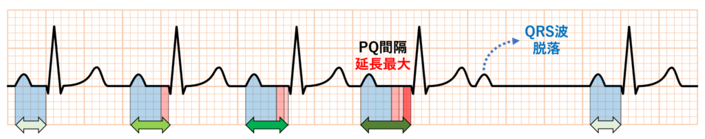 非定型Wenckebach型Ⅱ度房室ブロック(atypical Wenckebach second degree AV block)