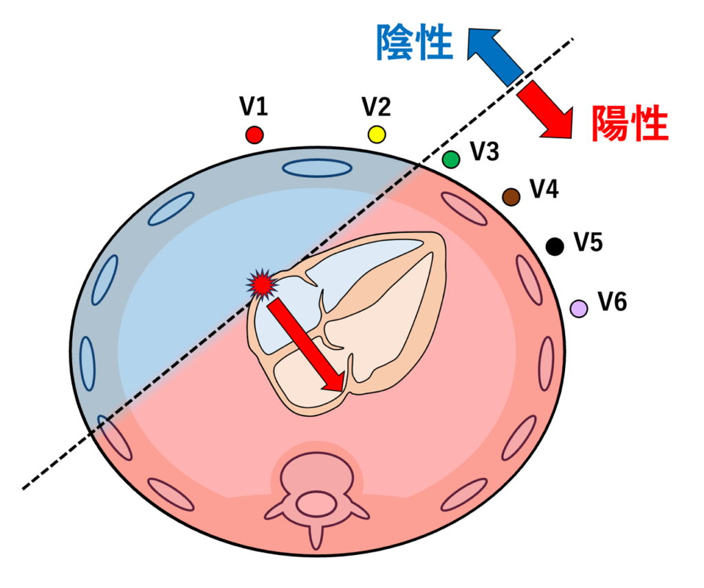 右心耳起源
特にV1–V2陰性からV3以降で陽性化するパターンは、右心耳起源を強く示唆します。
