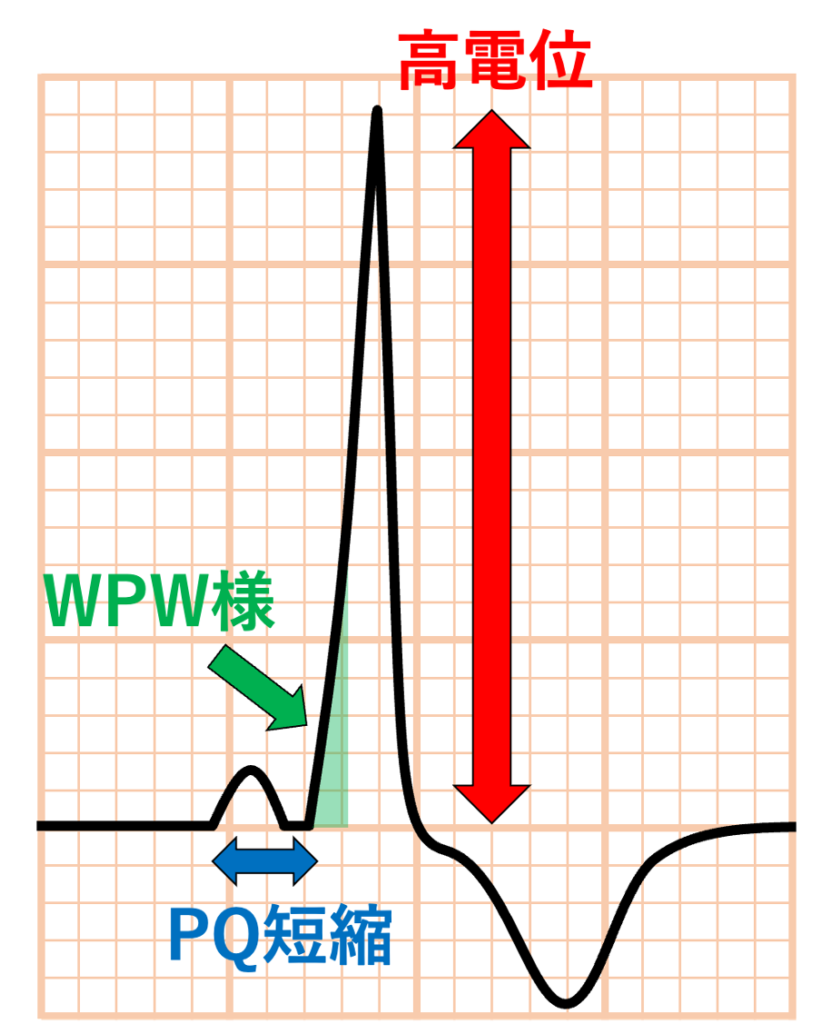 Danon病