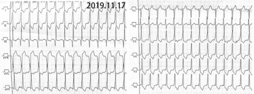 Danon病
Danon病では、心筋細胞内に自己貪食空胞などが蓄積し、特に男性では若年から高度な左室肥大を呈します。この心筋量の増大を反映して、胸部誘導を中心に非常に大きなR波・S波が出現し、一般的な左室肥大の電位基準を大幅に超えることがあります。ただし、Danon病の高電位は心筋肥大だけでは説明できない場合があります。