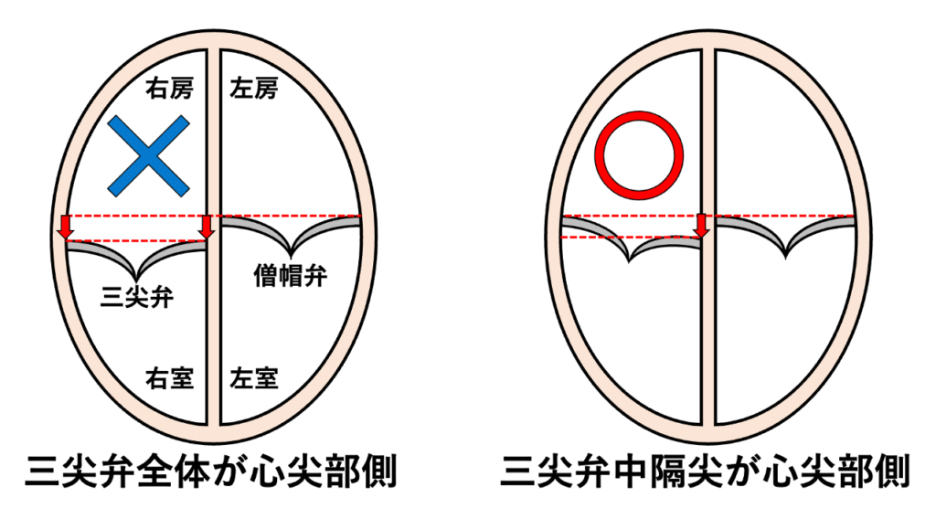 AV valve offset
ただし、三尖弁全体が僧帽弁より心尖部側に付着しているわけではなく、あくまで中隔側付着部のずれです。
