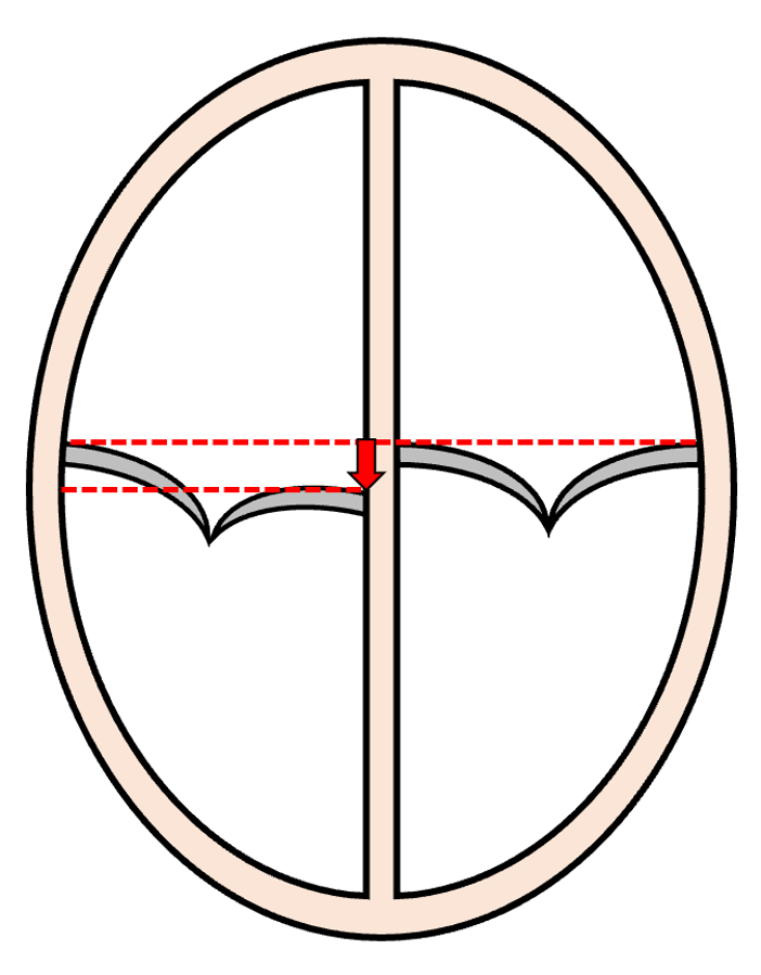 AV valve offset