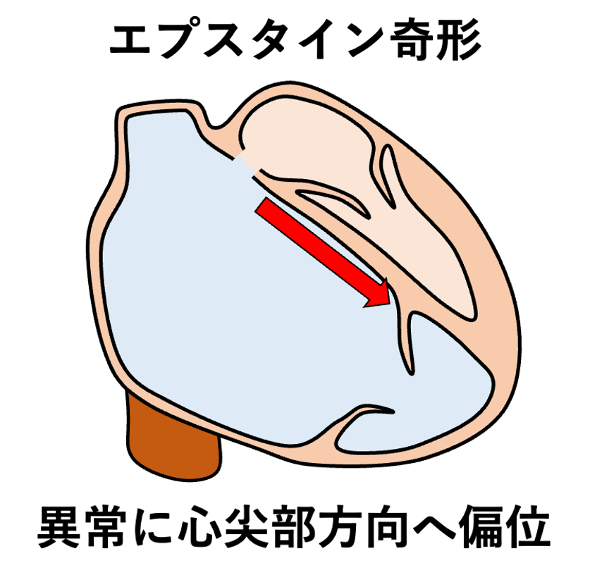 AV valve offset
AV valve offsetは正常な解剖学的特徴ですが、エプスタイン奇形では三尖弁中隔尖などの付着部が異常に心尖部方向へ偏位するためその程度が増大します。
