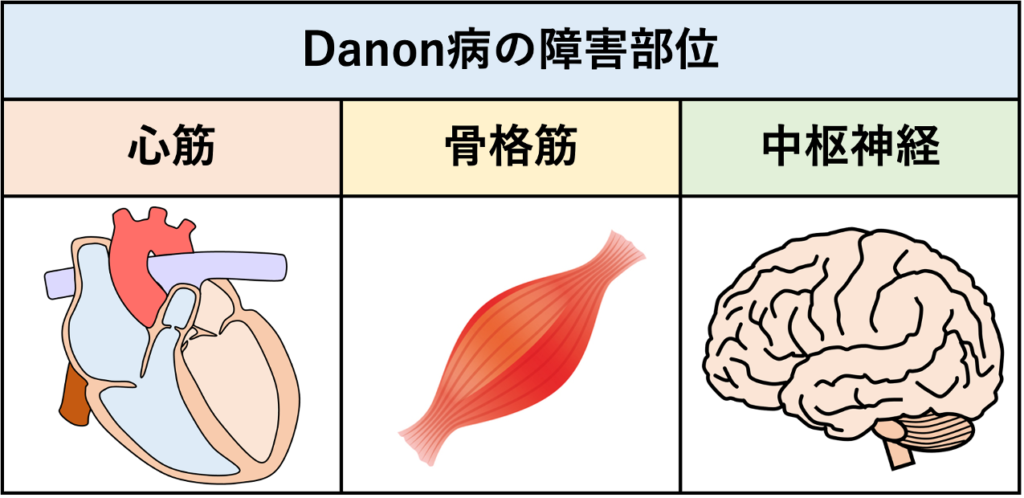 Danon病