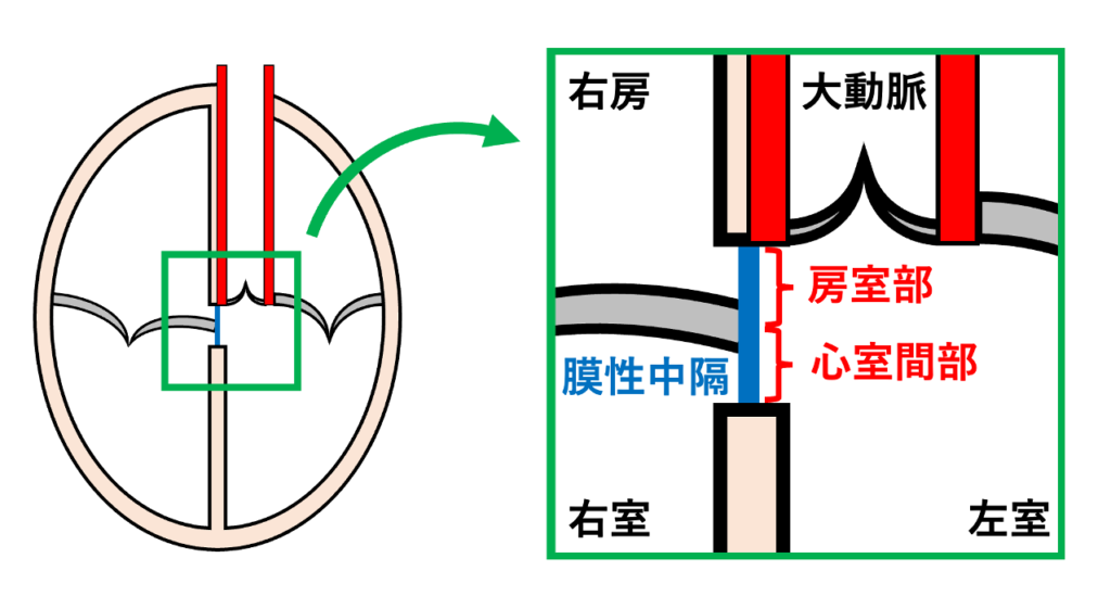 AV valve offset
この弁のずれにより、心室中隔の基部には、右心房と左心室が直接隣接する領域が形成されます。この領域には線維性組織である膜性中隔の房室部が存在し、右心房と左心室を隔てています。一方、膜性中隔のうち三尖弁中隔尖の付着部より心尖部側に位置する部分は、左右の心室を隔てる心室間部となります。