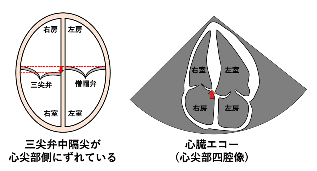 AV valve offset
AV valve offsetとは、三尖弁と僧帽弁の心室中隔側における付着位置の違いを指す解剖学的特徴のことです。Aは心房(Atrium)、Vは心室(Ventricle)のことであり、AV valveは心房と心室の間に存在する弁である三尖弁と僧帽弁、offsetはその房室弁付着部のずれを意味しています。正常心では、三尖弁の中隔尖は僧帽弁の中隔側付着部よりも心尖部側に位置しています。この位置のずれは、心エコーの心尖部四腔像ではっきりと確認でき、正常な心臓の形態を示す重要な所見の一つです。