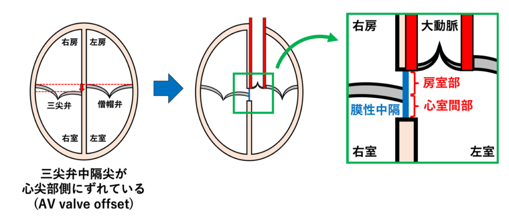膜性中隔(membranous septum)
このような構造が生じるのは、三尖弁の中隔尖が僧帽弁よりも心尖部側に付着しており、左右の房室弁の付着位置にずれ(AV valve offset)が存在するためです。
