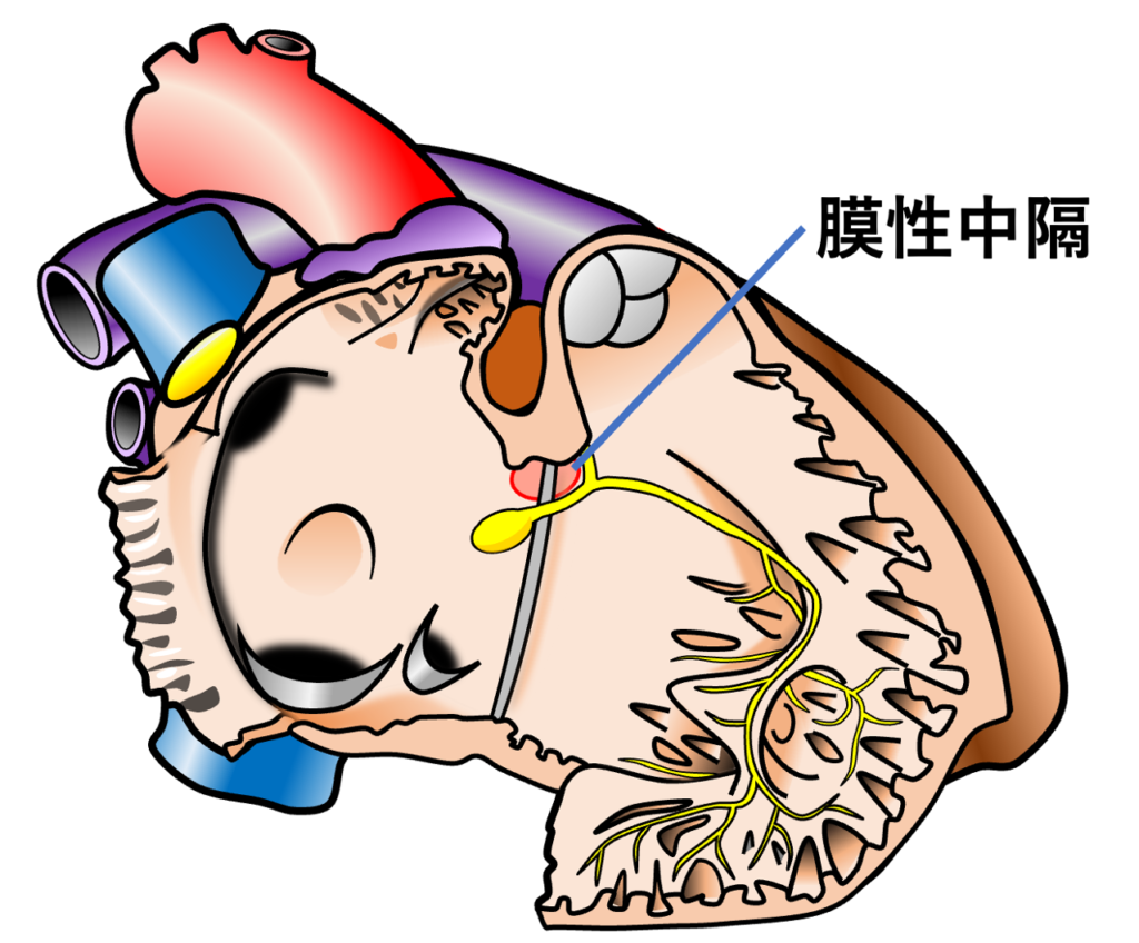 膜性中隔(membranous septum)
膜性中隔とは、心臓の中隔のうち筋組織が乏しく、主に線維性結合組織から構成される薄い膜状の部分です。心室中隔の大部分を占める筋性中隔とは異なり、心臓の線維性骨格(cardiac fibrous skeleton)と連続する構造です。