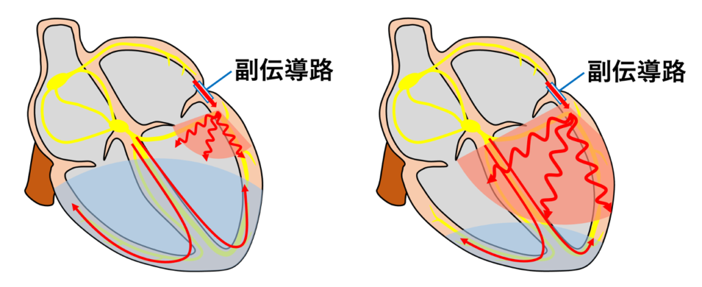 concertina effect
WPW症候群では、房室伝導(房室結節→His束→Purkinje線維)と副伝導路(ケント束)の2つの経路から生じる興奮が心室筋で融合するため、それぞれの興奮が心室に到達するタイミングによってデルタ波やQRS波形が変化します。