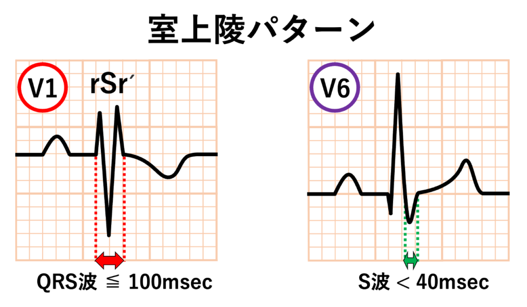 室上稜(supraventricular crest)
室上稜パターンとは、V1誘導などでみられる rSr′型QRS波のうち、右脚ブロックではなく右室流出路付近の室上稜の正常な終末興奮によってQRS波の終わりに小さなr′が形成される正常亜型を指すパターンです。