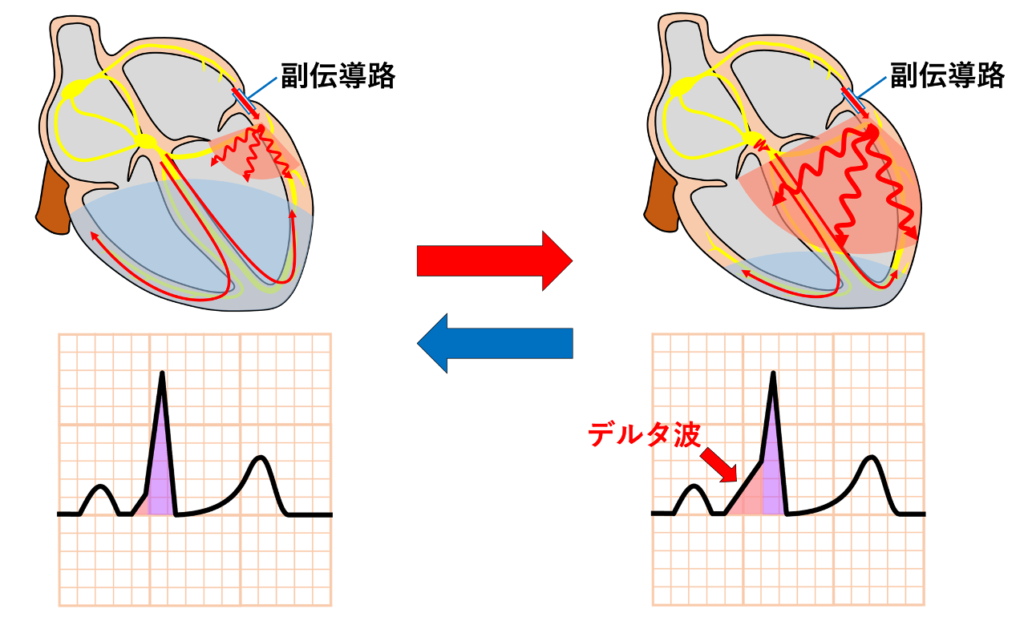 concertina effect
房室結節の伝導が徐々に遅延すると副伝導路を介して興奮する心室筋の割合が増加してデルタ波が徐々に顕著になります。逆に、房室結節の伝導が改善すると正常伝導系による心室興奮の寄与が増加してデルタ波は徐々に小さくなります。そのためデルタ波の程度が変化するのに伴い、PR間隔とQRS波が心拍ごとに変化します。