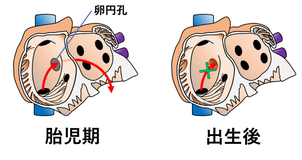 ユースタキオ弁(Eustachian valve)
胎児期には下大静脈から右心房に流入した酸素に富む血液を卵円孔を通じて左心房へ誘導する役割がありますが、出生後は肺循環が確立するためこの機能は不要になって退縮します。成人では小さな膜状構造として残存することが一般的ですが、個人差が大きく、ほとんど確認できない場合もあれば、右心房内に大きく突出する場合もあります。