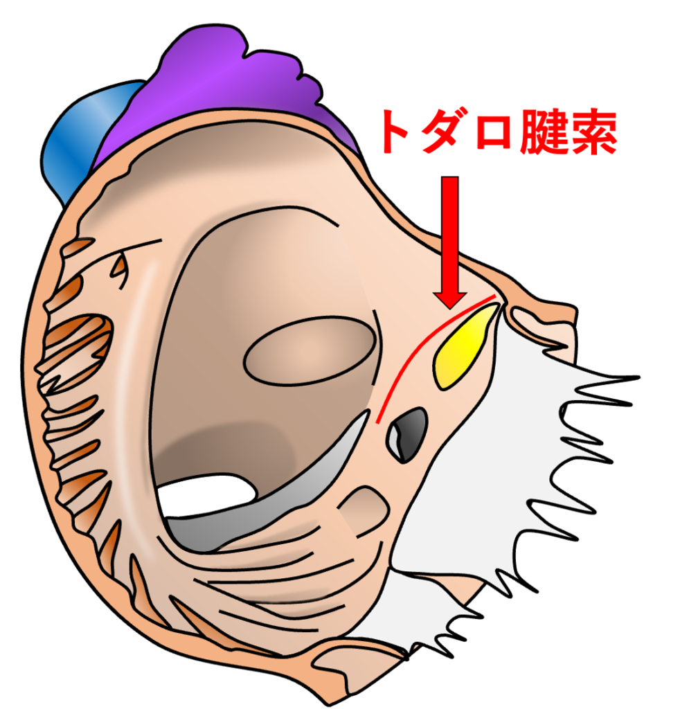 トダロ腱索(tendon of Todaro)
トダロ腱索とは、右心房内に存在する線維性の索状構造であり房室結節の位置を推定するうえで重要な解剖学的指標です。下大静脈入口部に存在するユースタキオ弁(下大静脈弁)の線維性延長として形成され、心房中隔側を前上方へ走行して中心線維体(central fibrous body)付近に至ります。通常、心内膜下を走行するため肉眼的に明瞭な索状構造として確認できるとは限りません。トダロ索はユースタキオ稜(Eustachian ridge)と解剖学的に連続していますが、トダロ腱索は線維性の索状構造、ユースタキオ稜は右房内面の隆起を指し、厳密には異なる構造です。