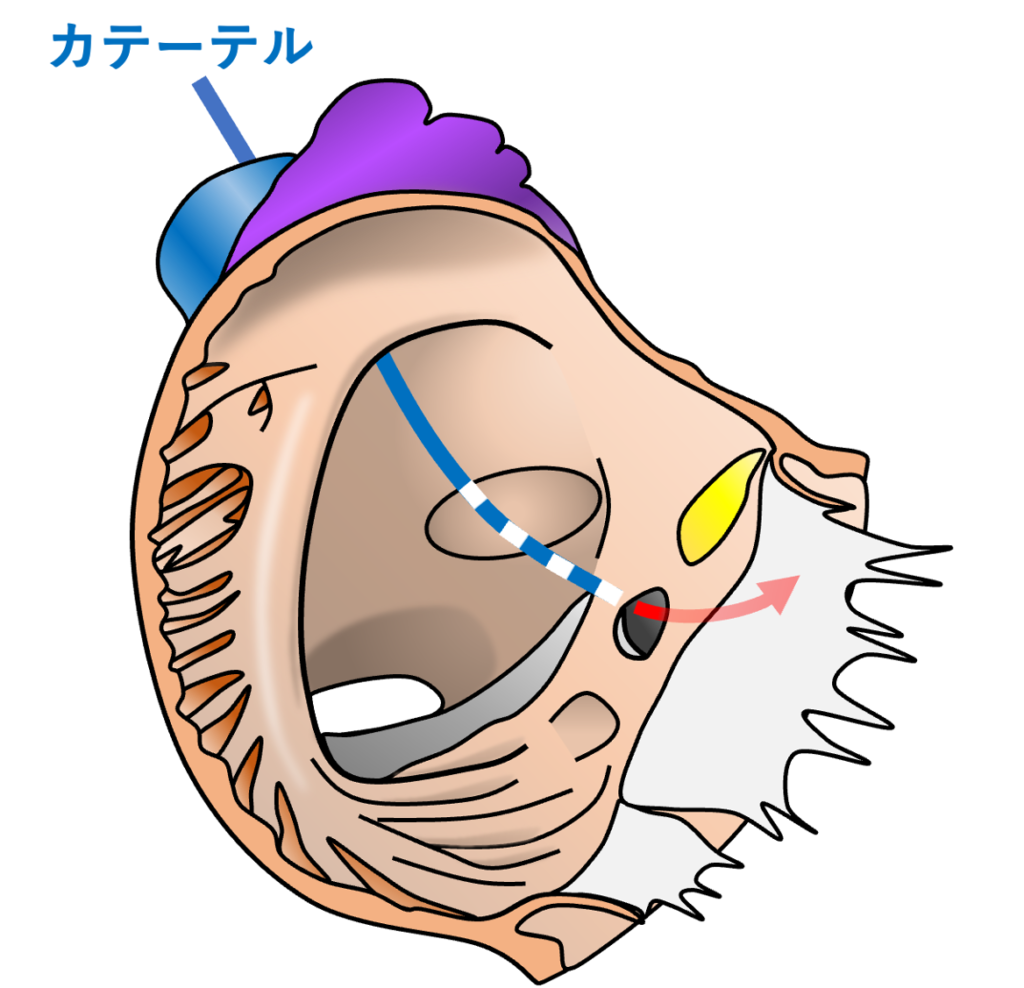 テベシウス弁(Thebesian valve)
臨床的には冠静脈洞へのカテーテル挿入において重要な構造です。特に発達したテベシウス弁は電気生理学的検査での冠静脈洞カテーテル留置や心臓再同期療法(CRT)における左室リード留置の障害となることがあります。