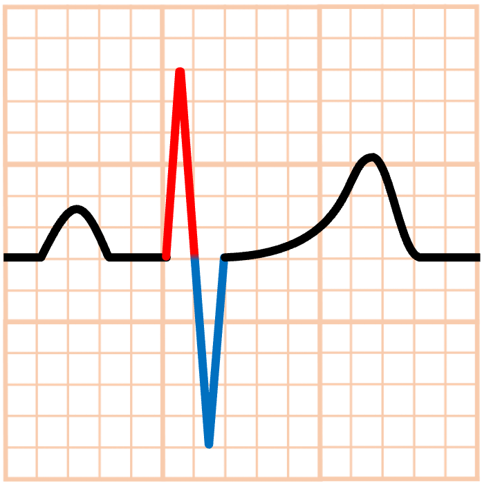 移行帯の心電図波形