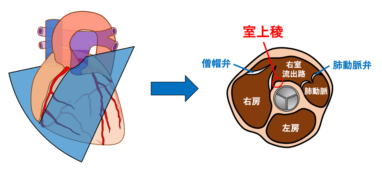 室上稜(supraventricular crest)
室上稜の前上方には右室流出路と肺動脈弁があり、後下方には三尖弁が近接します。また、後方には大動脈基部・大動脈弁が位置するため、右室内から見ると大動脈基部を覆うような位置関係になります。心エコーの大動脈弁レベルの短軸像で室上陵の一部を確認することができます。