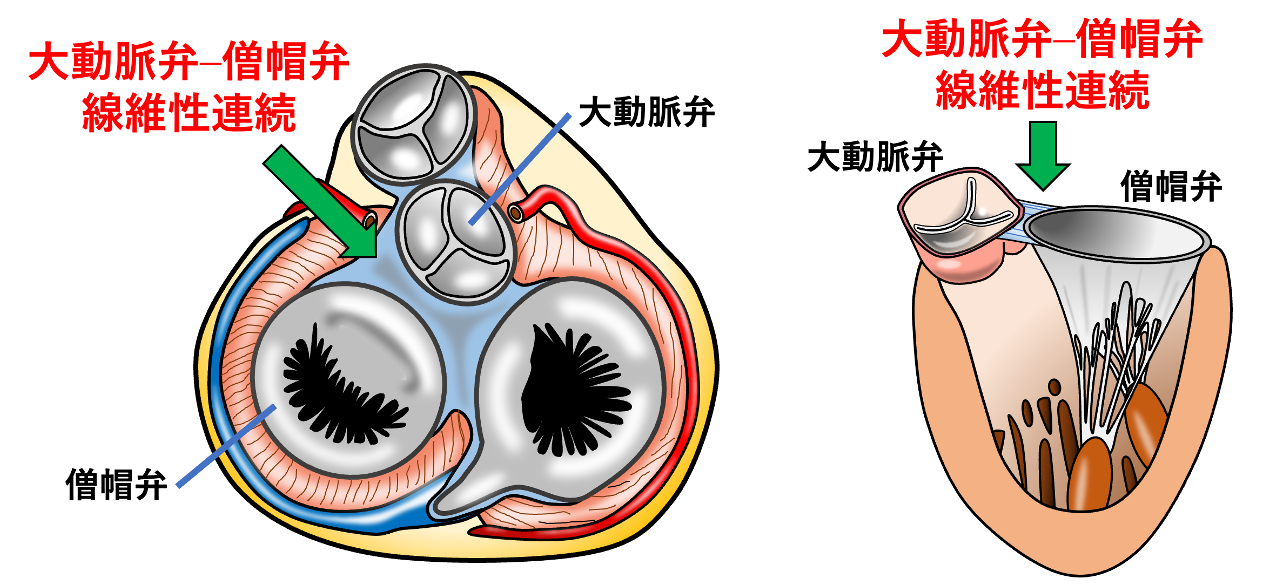 大動脈弁–僧帽弁線維性連続(aortomitral fibrous continuity)
